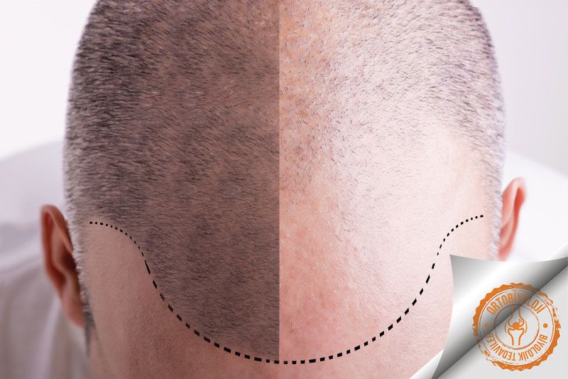 Stem cell hair transplantation stands out as one of the newest and innovative methods in hair loss treatment. In this procedure, the hair follicles are renewed and strengthened by utilizing the person's own stem cells. Stem cells are cells that support the body's natural healing and regeneration process. In this method, a small sample of hair follicles is first taken and stem cells are multiplied in a laboratory environment. These cells are then injected into balding areas to stimulate hair growth. Stem cell hair transplantation not only stops hair loss but also strengthens and improves the quality of existing hair. In addition, the recovery time after the procedure is faster and the results have a natural appearance.