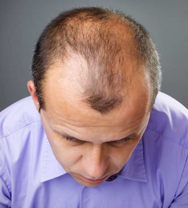 Hair transplantation is a permanent treatment for people who experience hair loss due to genetic hair loss, aging, hormonal changes or trauma. In this procedure, healthy hair follicles, usually taken from the back of the head, are transplanted to balding areas to give a natural appearance. The most common techniques include FUE (Follicular Unit Extraction) and FUT (Follicular Unit Transplantation). Hair transplantation is a procedure performed under local anesthesia and is completed with minimal discomfort. As a result, the transplanted hair is permanent and grows naturally over time, giving the person a younger and more confident appearance.