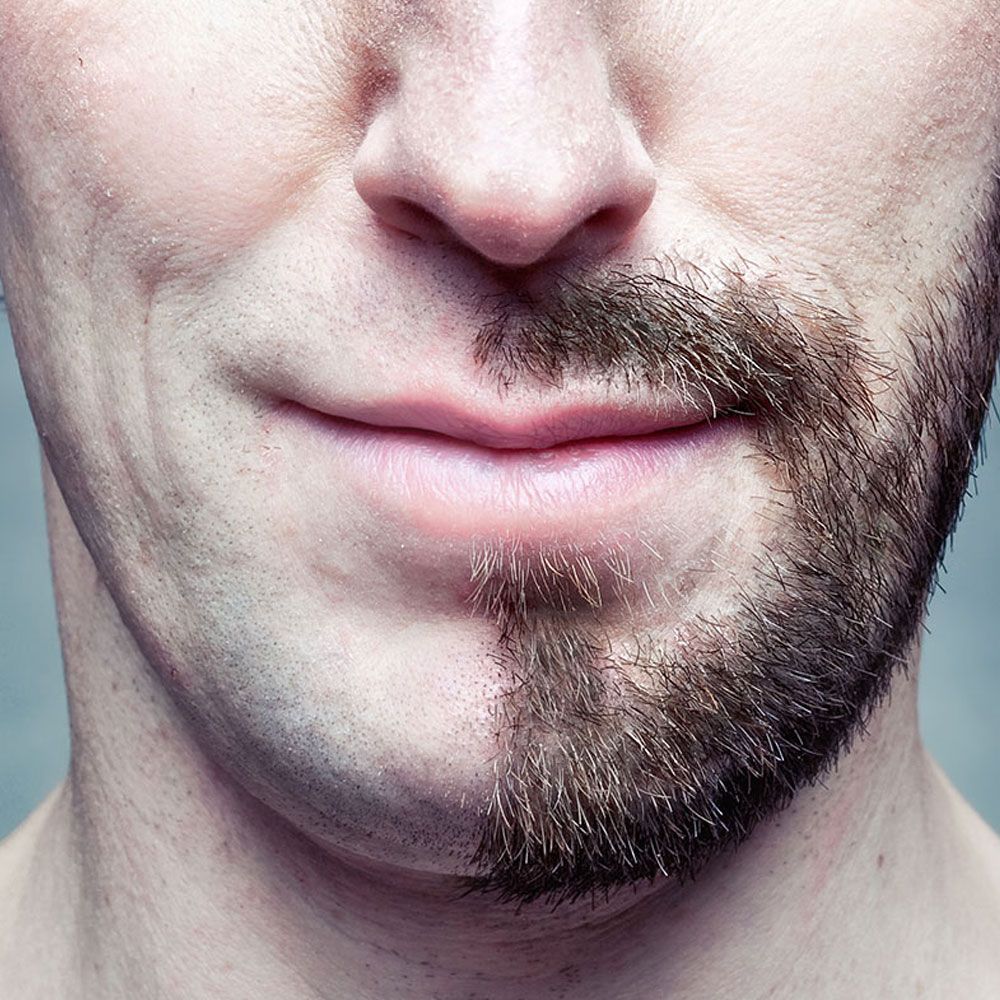 Beard transplantation is an effective method used in the treatment of problems such as beard sparseness, regional shedding or no beard growth. In this procedure, grafts taken from the person's own hair follicles are transferred to the areas where the beard is missing or sparse. Generally, hair follicles are taken from the nape of the neck and carefully placed to provide a natural appearance. Beard transplantation is planned in accordance with facial contours and the new beard can be shaved and styled after the procedure. The recovery period is short and the results are usually permanent and natural looking. This method is an ideal solution for people who want to add density to their beard or who want to improve their aesthetic appearance.